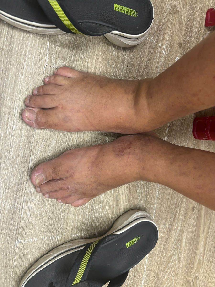 Traveler with significant swelling of the right foot and ankle compared with the left foot after recent air travel in Da Nang Vietnam