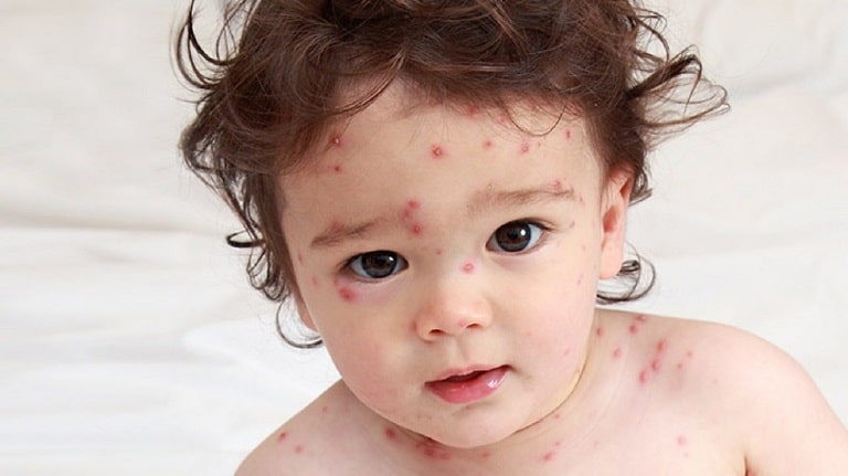 biểu hiện của dị ứng hải sản