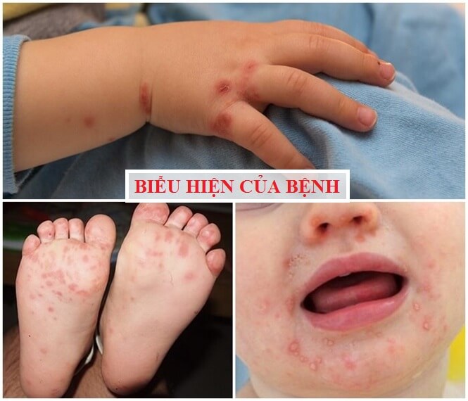 các bệnh truyền nhiễm thường gặp ở trẻ em