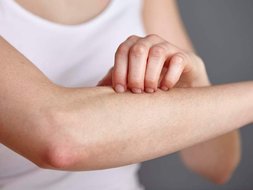 dị ứng vỏ tôm cua 